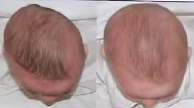 Bébé et plagiocéphalie – mon bébé a la tête plate ! - Cabinet d'ostéopathie  de Retournac